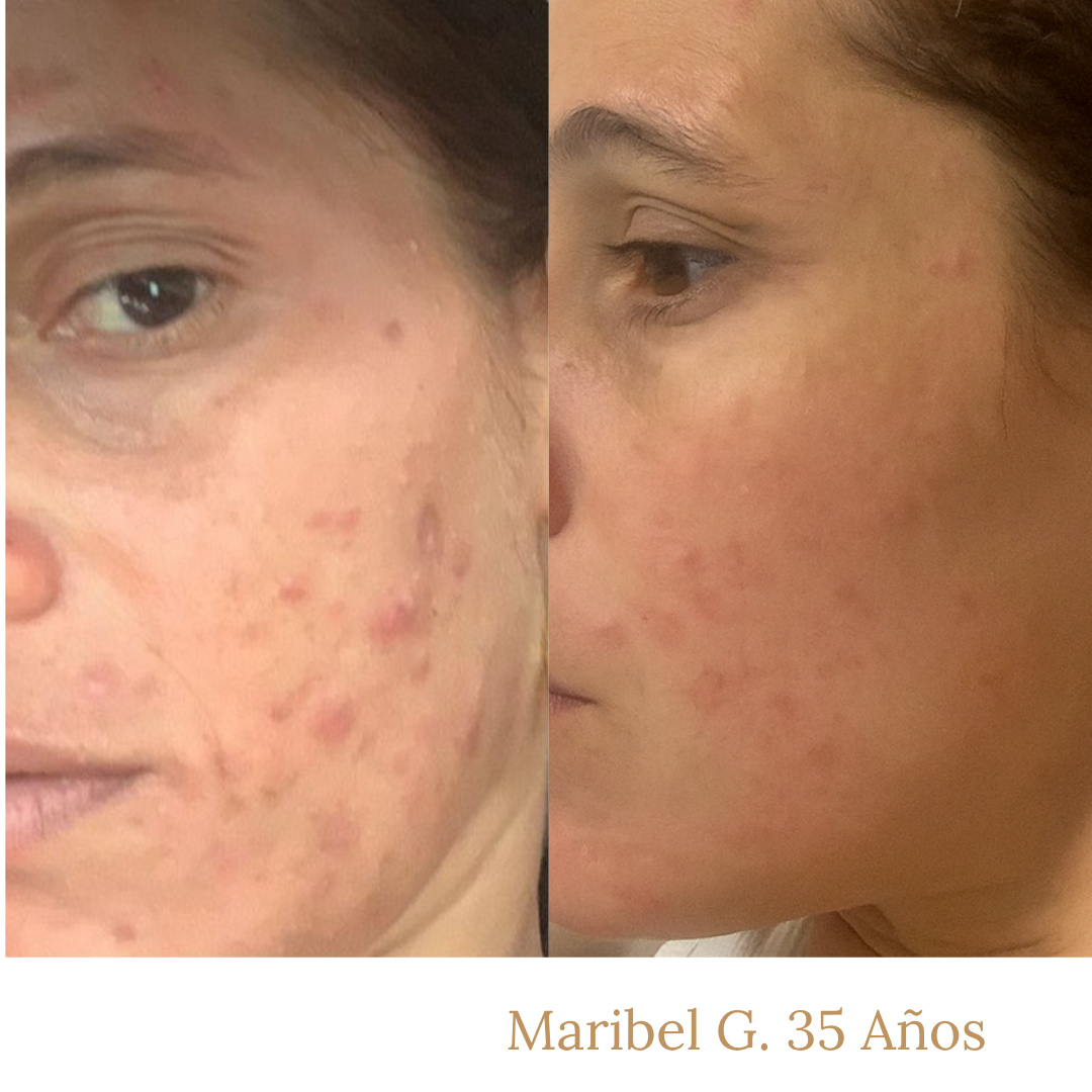 Before and after comparison of a woman's face with visible acne, showing improvement over time.