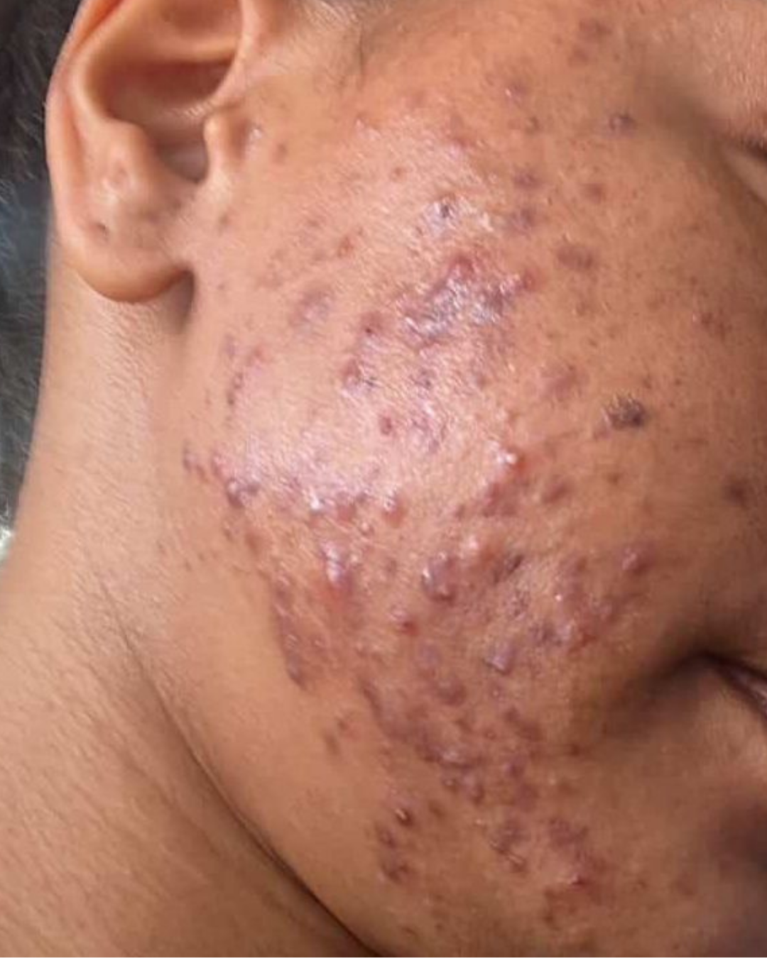 Antes Marcas y manchas post-acné