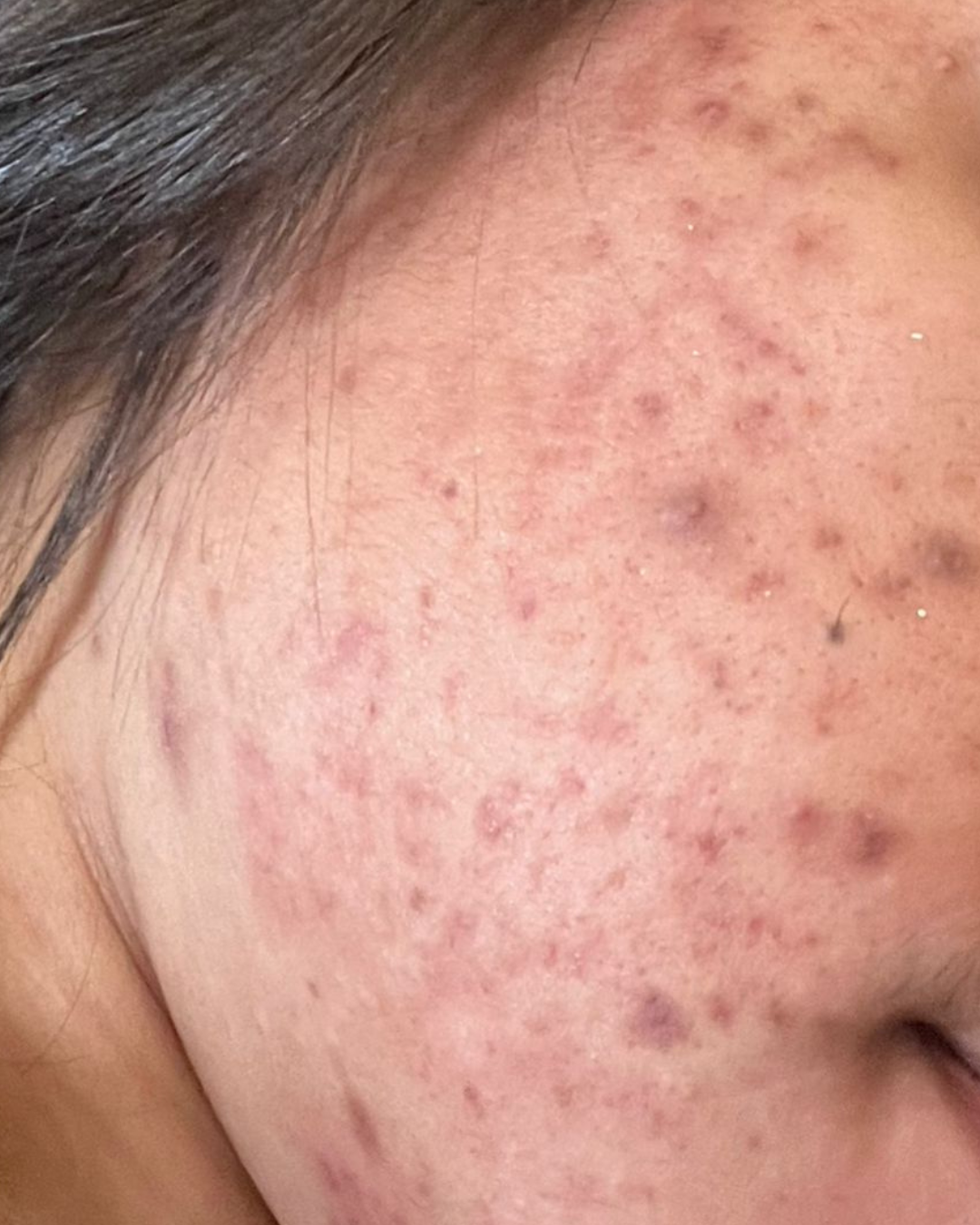 Después Marcas y manchas post-acné