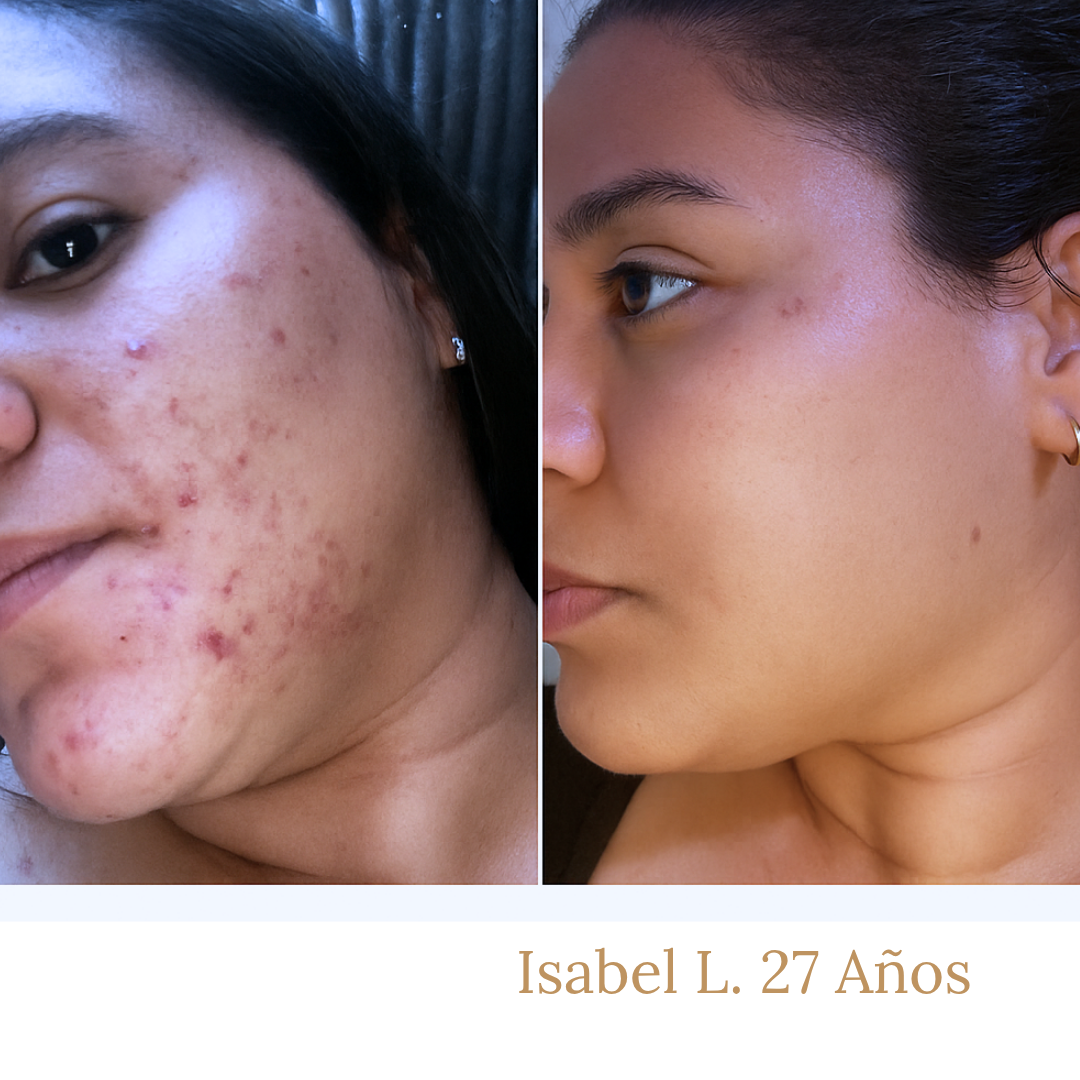 Before and after comparison of a woman's face with acne on the left and smoother skin on the right, labeled 'Isabel L. 27 Años'.
