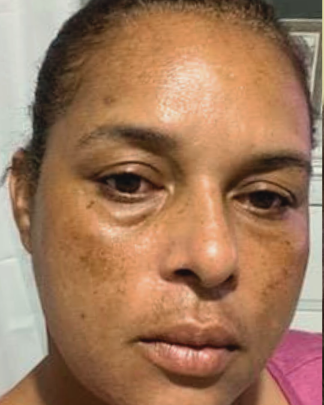 Antes Manchas de sol y edad