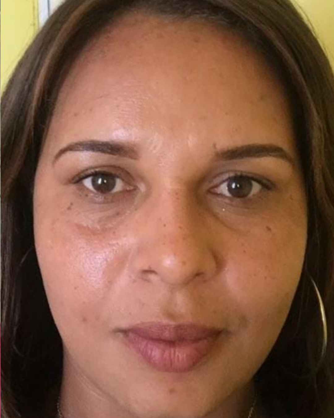 Después Manchas de sol y edad