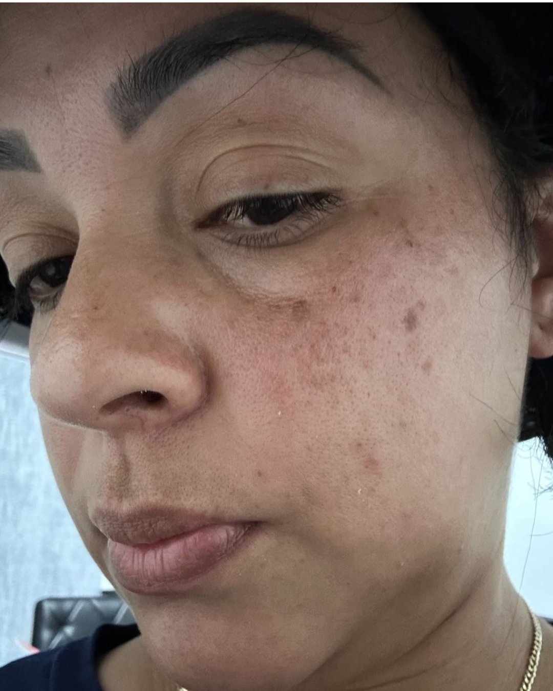 Antes Hiperpigmentación