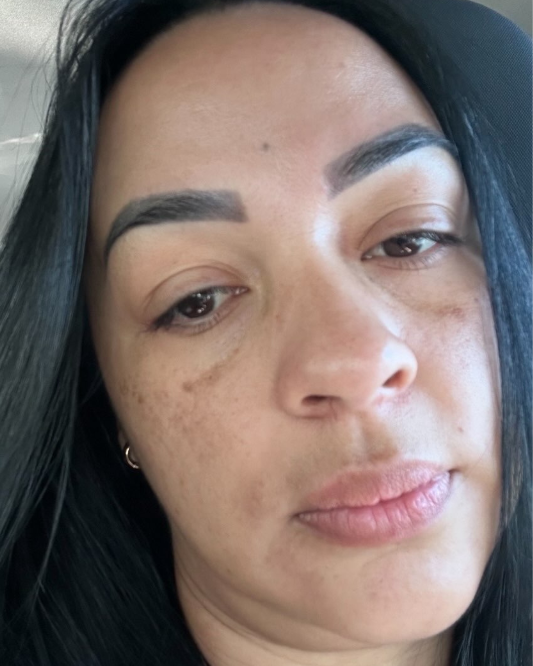 Después Hiperpigmentación