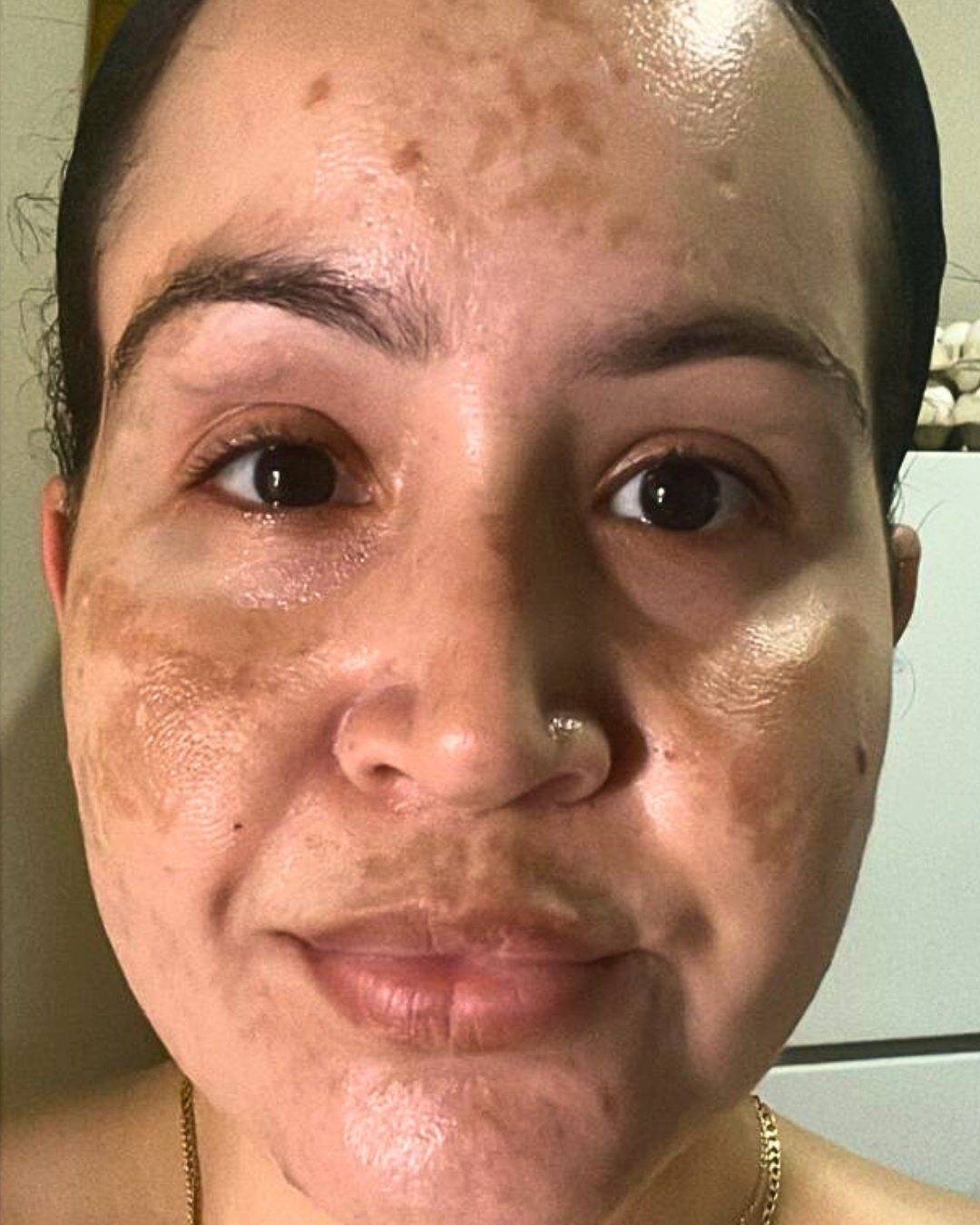Antes Melasma (paño hormonal)